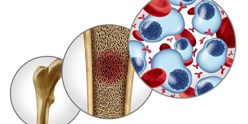 Multiple myeloma